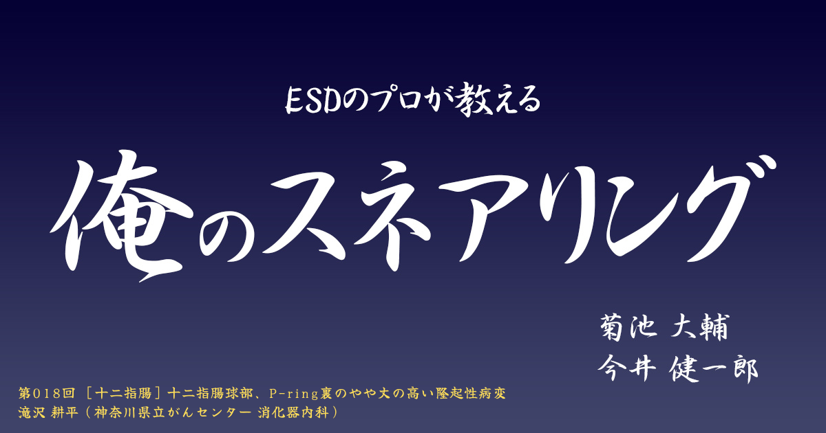 ESDのプロが教える「俺のスネアリング」　<br>第018回 ［十二指腸］十二指腸球部、P-ring裏のやや丈の高い隆起性病変　<br>滝沢 耕平（神奈川県立がんセンター 消化器内科）